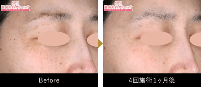 湘南美容外科の西川礼華医師が担当した新フォームXの4回施術1か月後の症例画像