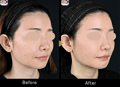 湘南美容外科の森川正一郎医師が担当した新フォームXの症例画像